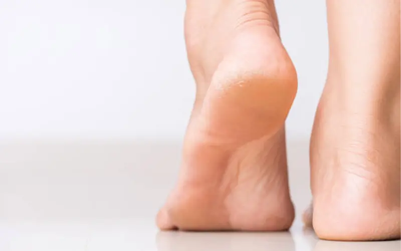 Corns and calluses treatment