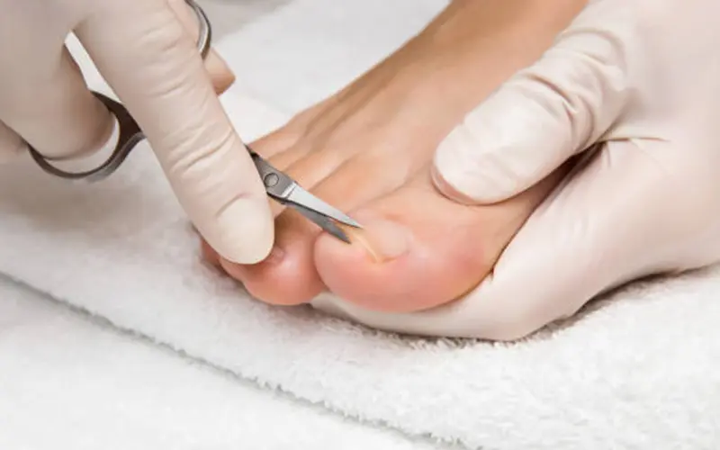 Treatment for Ingrown Toenails