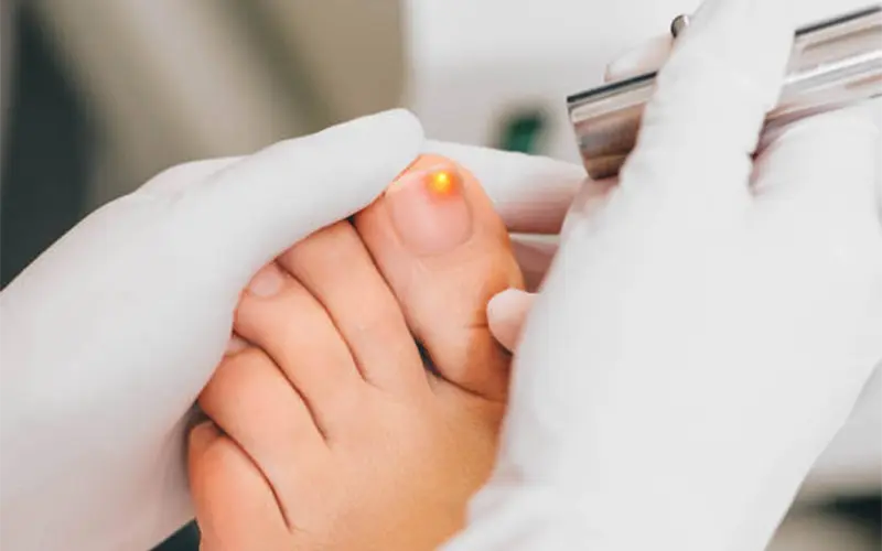 Laser Toenail Fungus Treatment