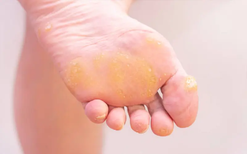 Treatment for Skin Growths and Lesions