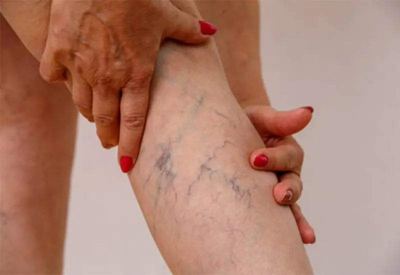 Vein Disease Treatment 