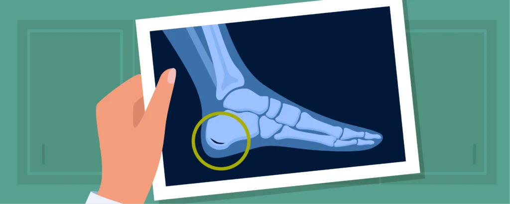 Understanding Heel Pain