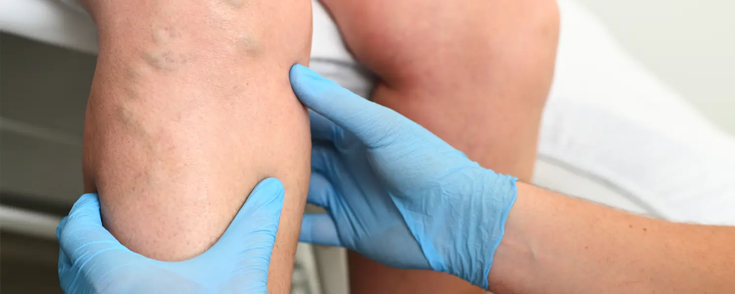 Varicose Veins, Upperline Health