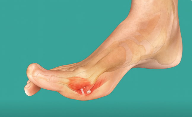 The Anatomy of Turf Toe